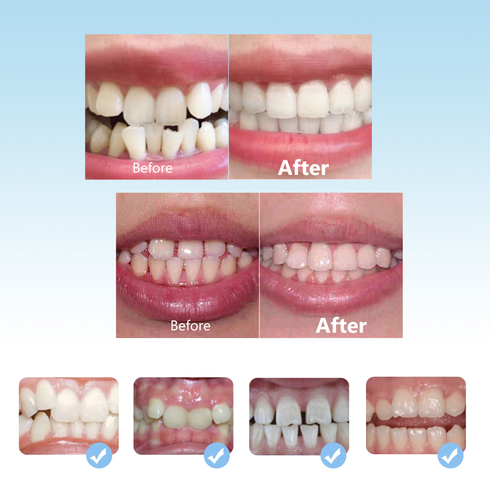Dental ortodôntico chaves conj - Teeth Whitening Mouth Guard avaliação e preço