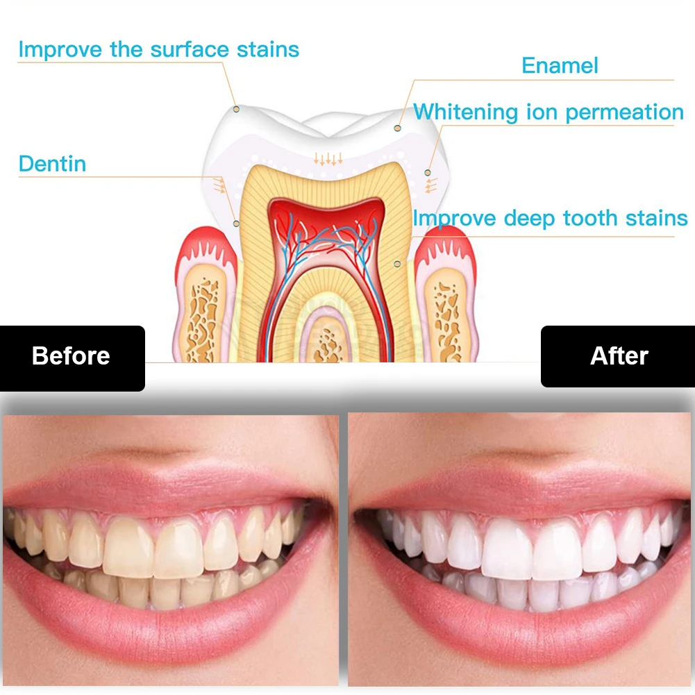 Kit de clareamento dental dos  - Whitening Pen Bleach avaliação e preço