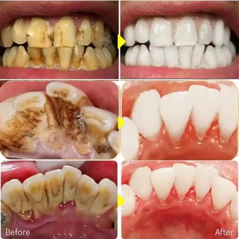 5 Pontas de Ultrassom Odontoló - Teeth Whitening Usa avaliação e preço