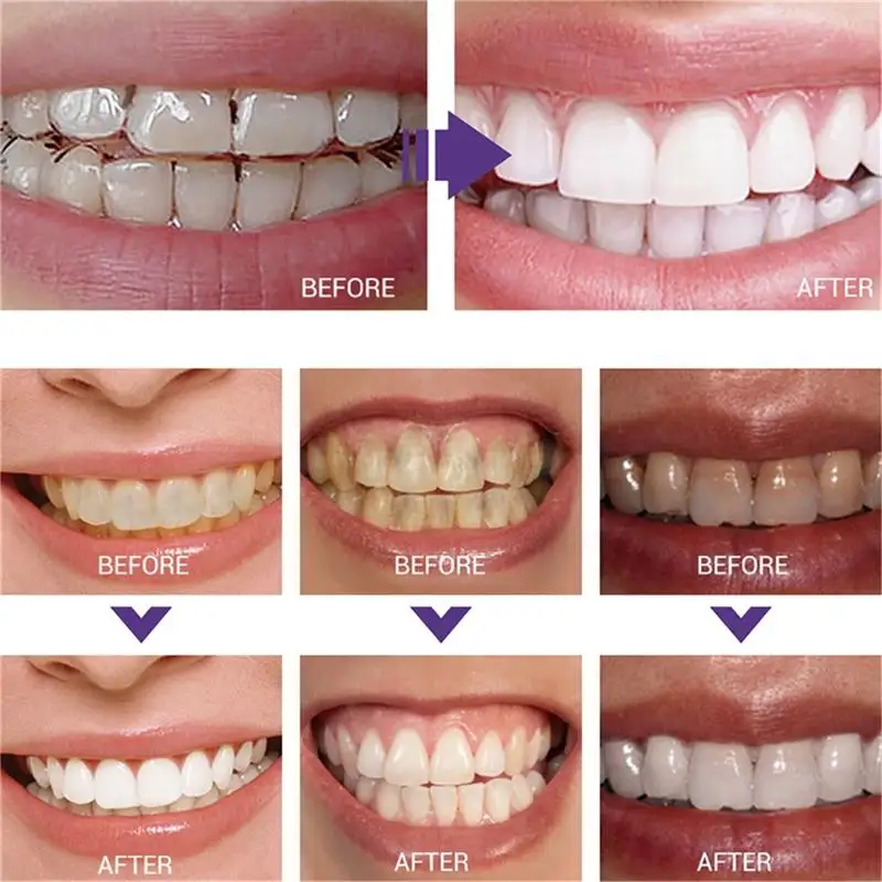 5 Pontas de Ultrassom Odontoló - Teeth Whitening Usa avaliação e preço